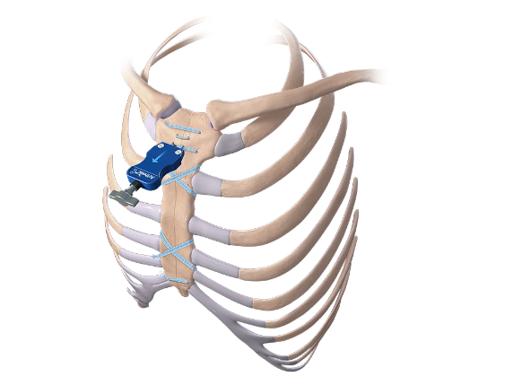 Arthrex - FiberTape Cerclage Disposable Tensioner - AR-7820